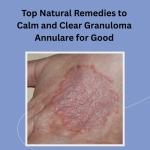 Top Natural Remedies to Calm and Clear Granuloma Annulare for Good